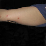 bouton punaises de lit bras