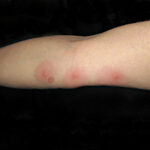 bouton punaises de lit bras