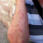 bouton punaises de lit bras