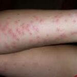 bouton punaises de lit bras