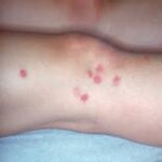 bouton punaises de lit bras