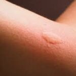 bouton punaises de lit bras